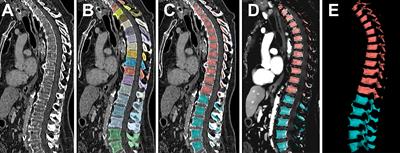 Physiological iodine uptake of the spine’s bone marrow in dual-energy computed tomography – using artificial intelligence to define reference values based on 678 CT examinations of 189 individuals